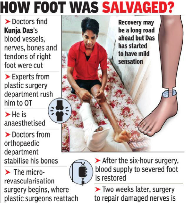 surgical-wizards-in-india-reattached-the-mans-foot-severed