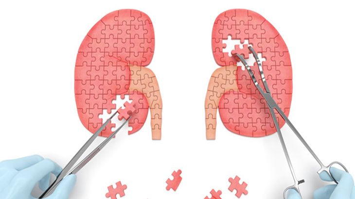 kidney-transplant-cost-in-bangalore