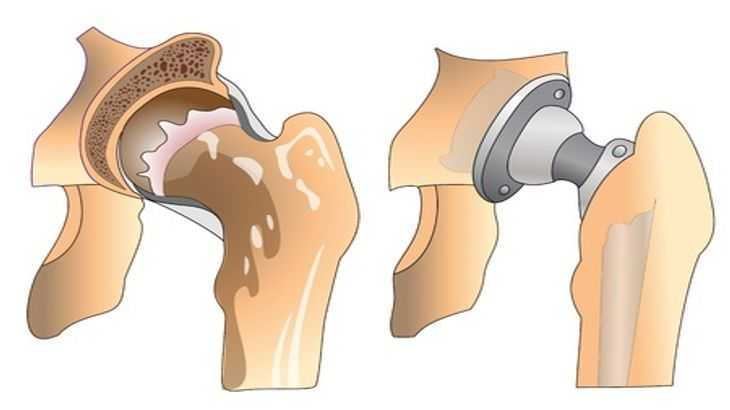 hip-replacement-cost-india