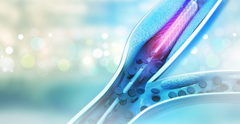 angioplasty
