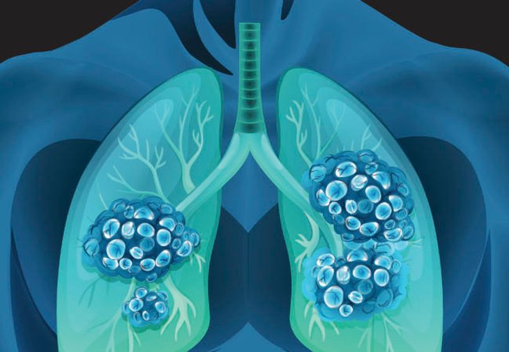 lung-cancer-symptoms