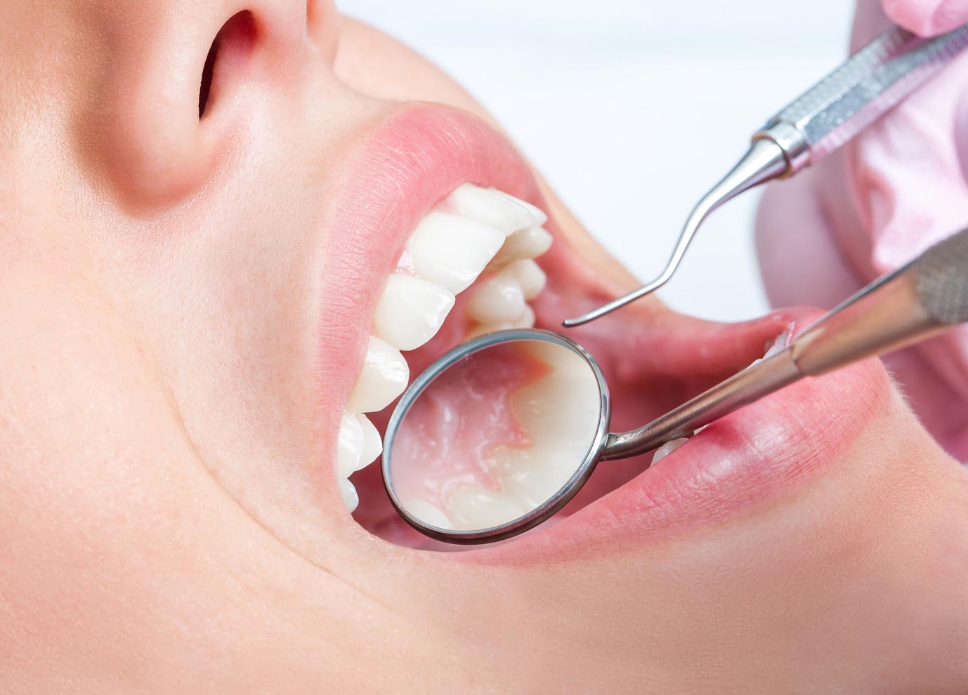 stages-of-oral-cancer-tnm-system