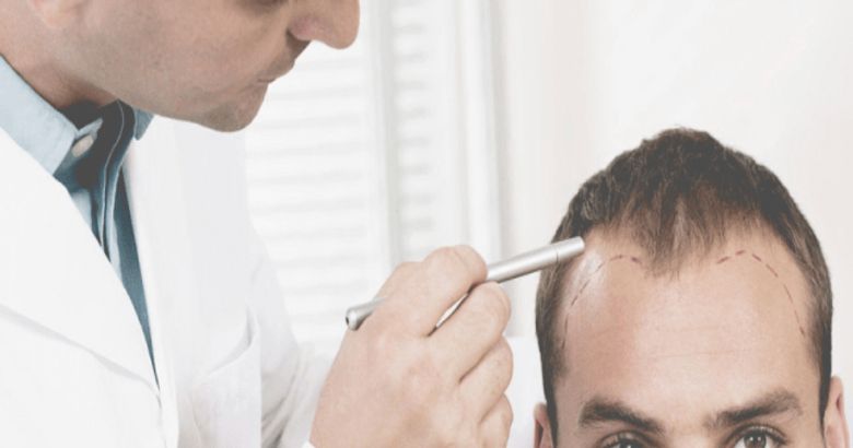 top-10-hair-transplant-surgeons-in-india