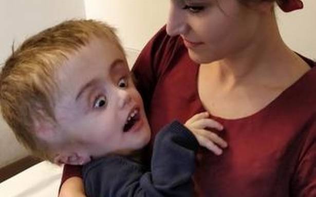 baby-afflicted-with-hydrocephalus-treated-successfully-in-india