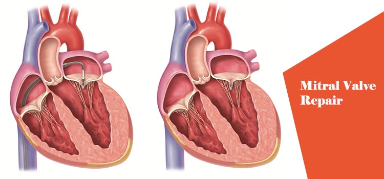 mitral-valve-repair