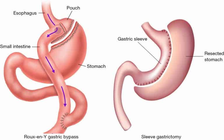obesity-surgery-cost-india