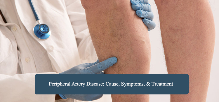 peripheral-artery-disease
