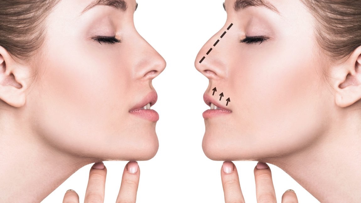 rhinoplasty-surgery