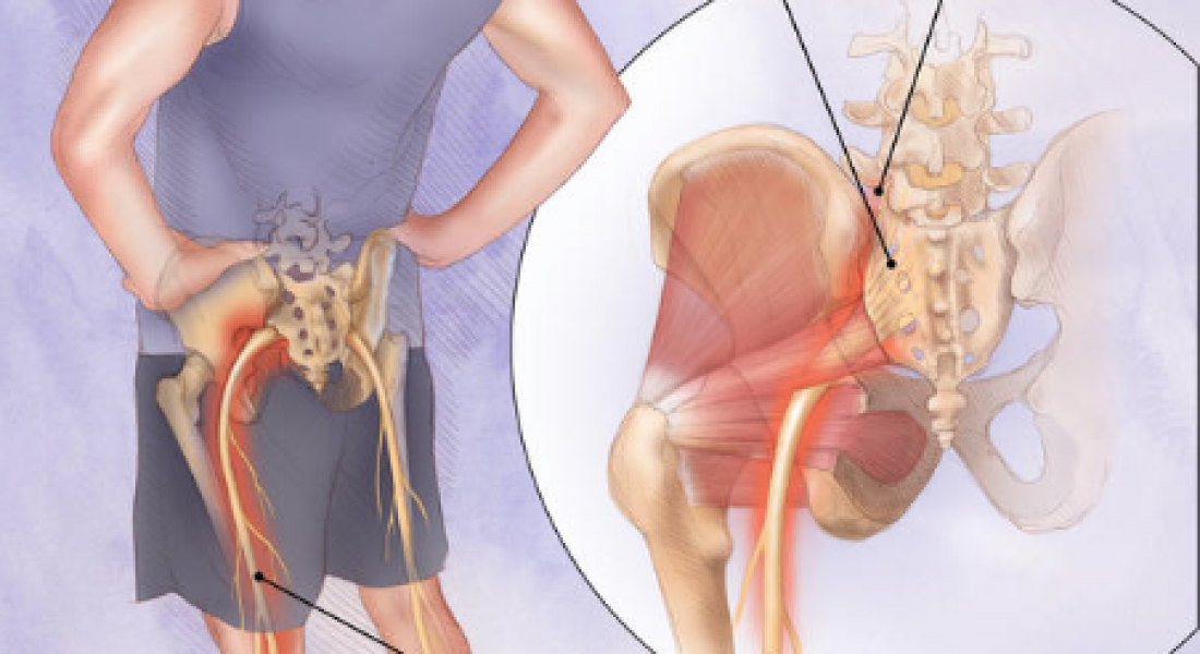 sciatica-treatment