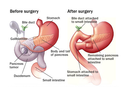 whipple-procedure-complications