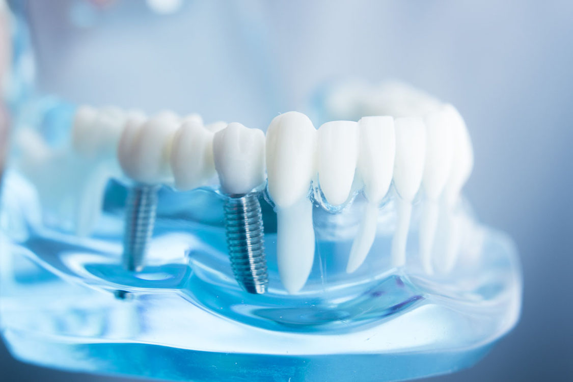 all-in-4-implants