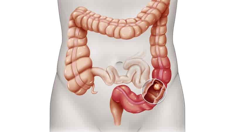 colon-cancer-treatment-cost-india
