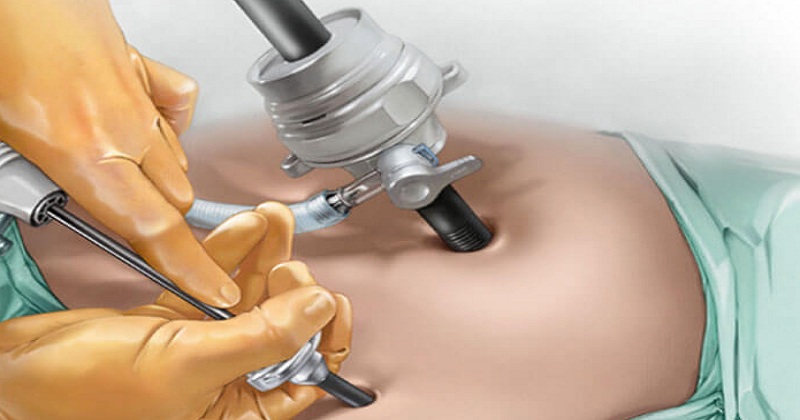 laparoscopy-cost-in-delhi