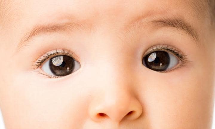strabismus