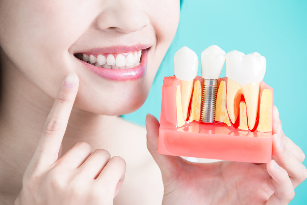 types-dental-implants