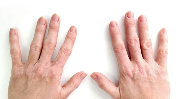 vitiligo-treatment-surgery-india-low-cost-best-doctors-hospitals