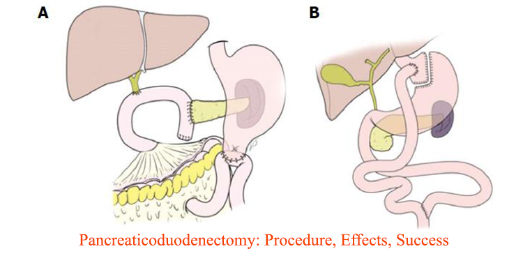 whipple-procedure-success-rate